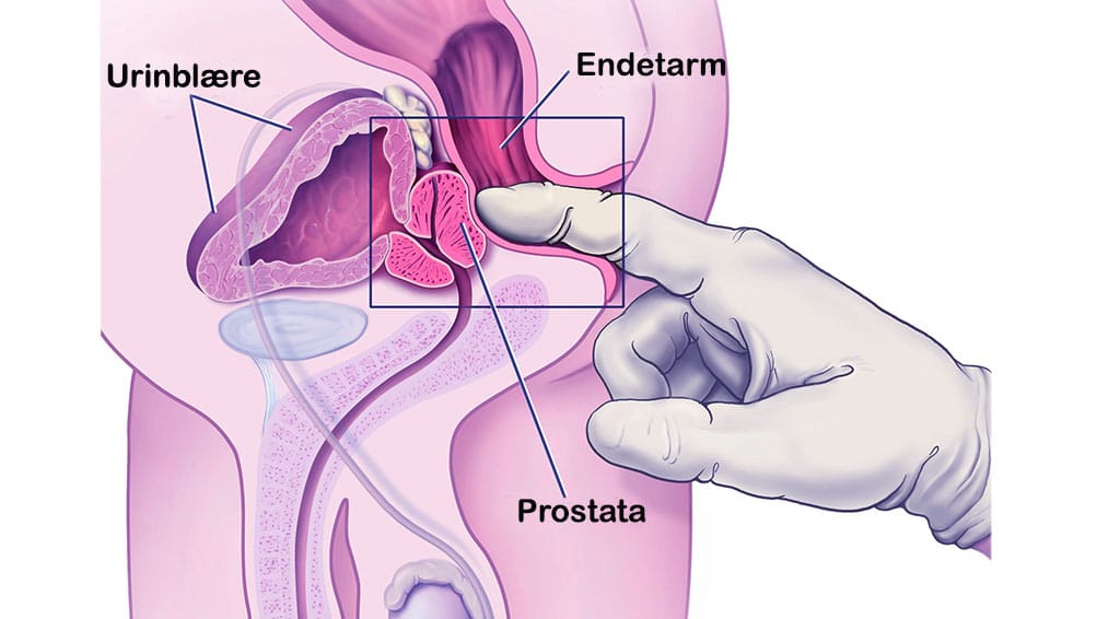 stimulere prostata - prostata massasje